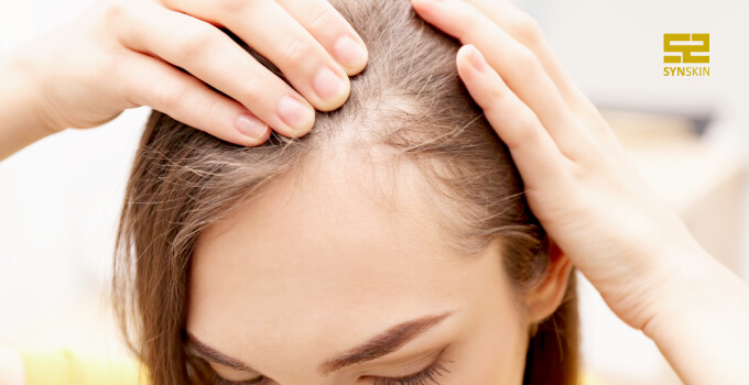 ریزش موی سکه ای چیست و چگونه درمان می شود؟