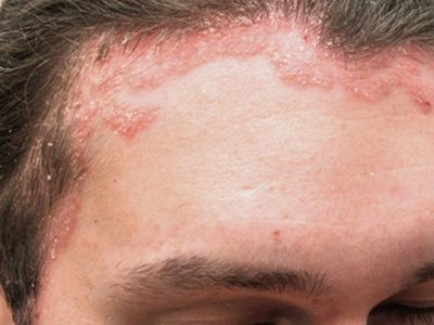 پسوریازیس پوست سر چیست و چگونه درمان می_شود؟ 