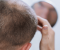 ریزش موی هورمونی چه علائمی دارد و راه درمان آن چیست؟